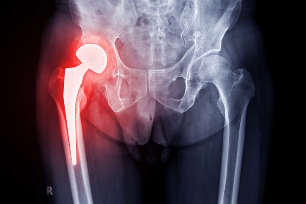 Glucosamine